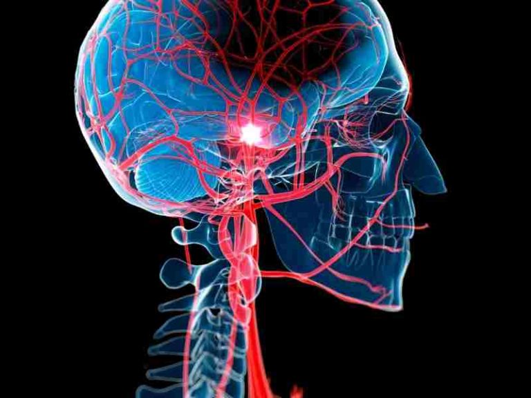Stroke Iskemik Adalah